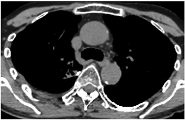 Postoperative CT revealing that the stapler dividing the lung parenchyma directly touched the fifth vertebra (arrow).