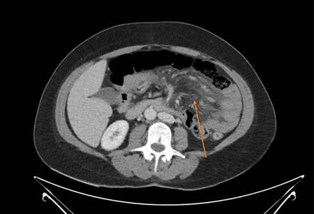 CT demonstrating jejunal wall thickening and mesenteric oedema (arrow).