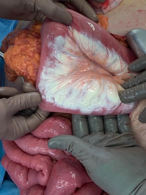 Operative photo demonstrating ‘white mesentery’ (chyle throughout small-bowel mesentery).