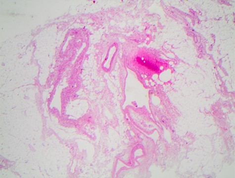 Section of the small-bowel mesentery showing dilated thin- and thick-walled lymphatic vessels, consistent with a cavernous lymphangioma.