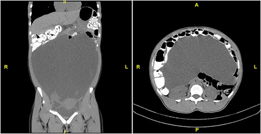 CT scan with PO and IV contrast demonstrating massive ascites and displacement of abdominal viscera. Left: coronal section. Right: transverse section at L1.