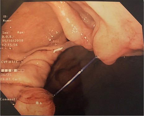 Endoscopic view during gastroscopy showing dehiscence of endoscopic sleeve gastroplasty sutures. This was taken 2 weeks prior to laparoscopic sleeve gastrectomy