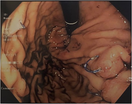 Retroflexed endoscopic view during gastroscopy showing dehiscence of endoscopic sleeve gastroplasty sutures. This was taken 2 weeks prior to laparoscopic sleeve gastrectomy