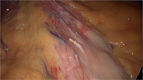 Laparoscopic view during sleeve gastrectomy reveals full-thickness invasion of endoscopic sutures and titanium clips through the gastric wall
