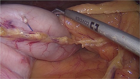 Laparoscopic view during sleeve gastrectomy reveals full-thickness invasion of endoscopic sutures and titanium clips through the gastric wall