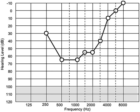 Patient’s audiological assessment 2 weeks after symptom onset.