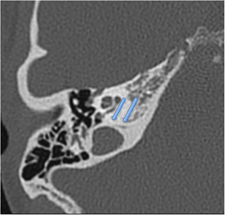 Patient’s CT scan showing an enlarged right cochlear aqueduct.