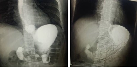 Parents’ barium swallow: (1) It shows on the left the asymptomatic hiatus hernia of the mother with reflux. (2) It shows on the right a reflux with the father who was symptomatic with no hernia.