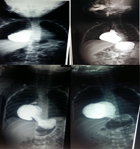 Upper left photo is of case two that shows a barium swallow with 5.5 cm hiatus hernia. The upper right photo is of case 4 that shows a barium swallow with 8 cm hiatus hernia. Lower 2 photos are of case 3 that show barium swallow with a 6 cm hiatus hernia.
