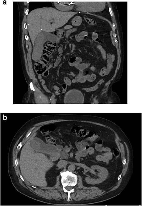 CT abdomen/pelvis without contrast. (A) Coronal and (B) axial slices depicting cholelithiasis, soft tissue within the gallbladder lumen and extrahepatic biliary ductal dilation