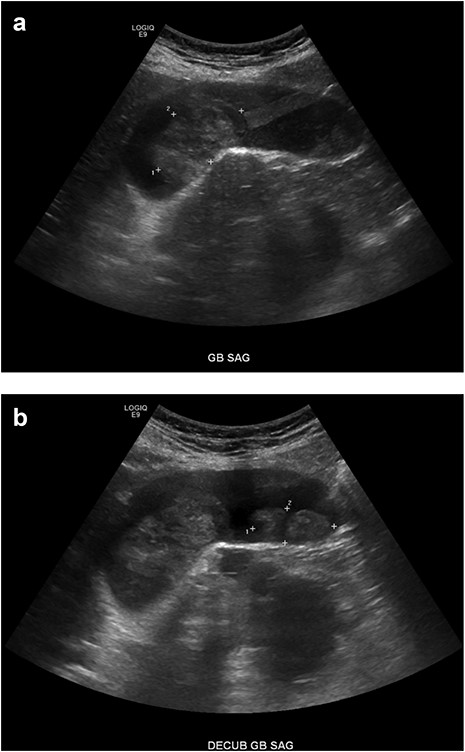 Right upper quadrant ultrasound. (A, B) A mildly distended gallbladder is visible containing two well-defined soft tissue masses within the gallbladder lumen, measuring 4.7 × 2.8 × 2.5 cm and 3.4 × 1.4 × 2.2 cm, respectively