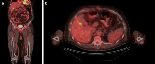 PET/CT. (A) Coronal and (B) axial slices depicting change status post cholecystectomy and focal uptake in the right hepatic lobe adjacent to the gallbladder fossa