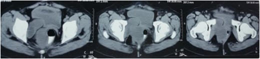 Preoperative CECT scan showing pararectal swelling.
