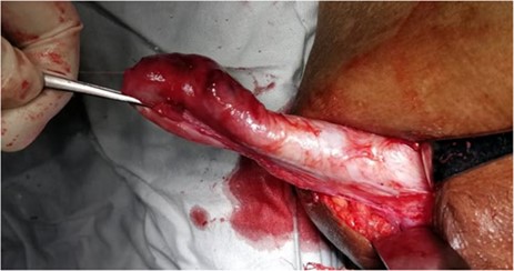 Intraoperative photograph showing pararectal tumour.