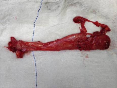 Specimen of excised pararectal mass lesion.