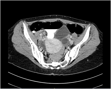Computed tomography scan in a transverse cut demonstrating an inflamed appendix
