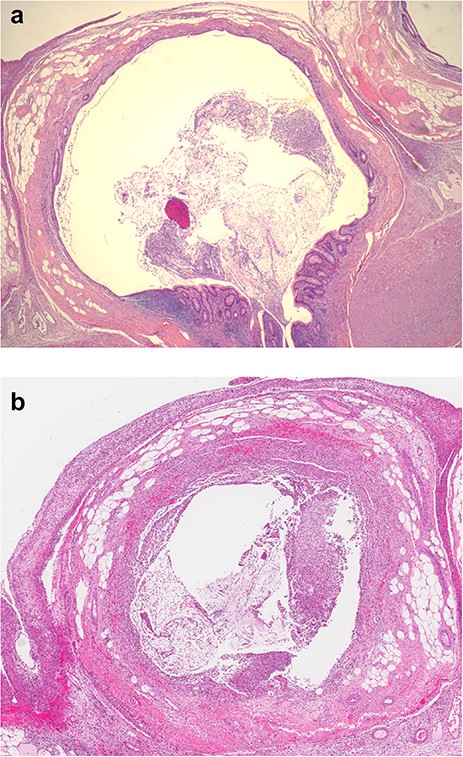 (a) Longitudinal section of appendix shows pseudodiverticulum. (b) Diverticulitis with peridiverticulitis and periappendicitis