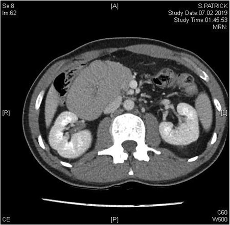 Between the head of pancreas and the lower edge of the liver, an oval-shaped, clearly defined convolution of small intestine loops measuring ~9.5 x 6.5 cm was visible. The duodenum could not be followed as expected—there is no duodenal part crossing the vessels to the left