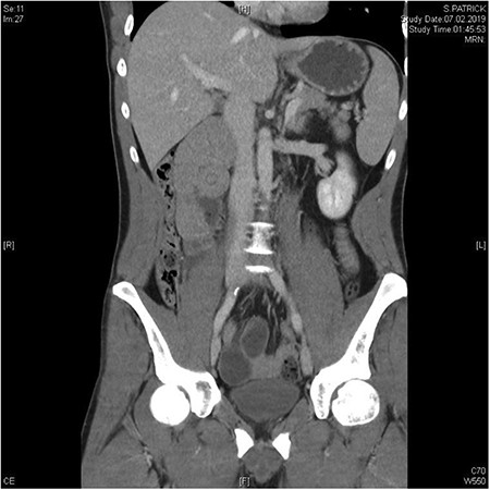In the coronal plane, in addition to the suspicion of an internal hernia, a short intussusception was also suspected. Furthermore, this level shows that the herniating small intestine is located on the right, while the left side of abdomen appears empty