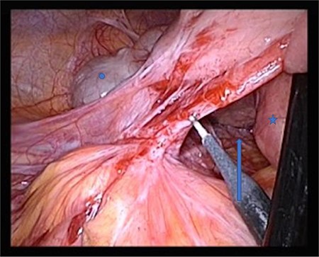 Star: duodenum, circle: cecum, arrow: Waldeyer’s fossa