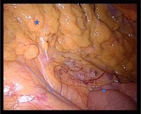 Star: transverse colon under the greater omentum, arrow: vessel axis, circle: proximal jejunum. The ligament of Treitz is not shown