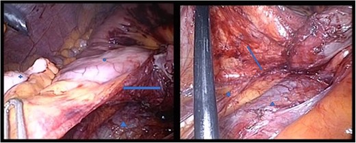 Both pictures display the hernia sac; in the right panel, the hernia sac has been elevated. Circle: terminal ileum, cross: appendix, star: ureter, triangle: V. cava, arrow: hernia sac, which has been opened