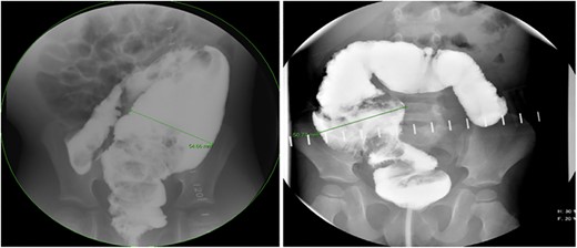 Representative contrast enema study. Note the lack of dilated proximal colon and defined transition zone in the low rectosigmoid colon. (Candidate for transanal only).