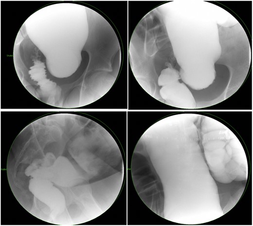 Representative contrast enema study of an older child with a large amount of proximal colonic dilation of the sigmoid and descending colon, seen here across multiple views during contrast enema (Not a candidate for transanal only).