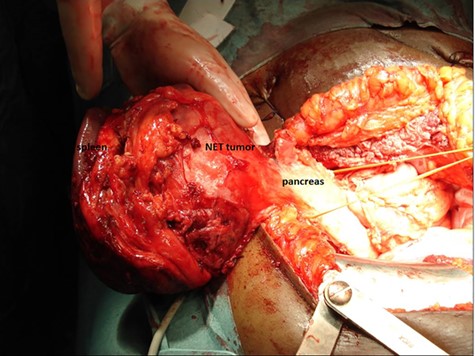 pNET with spleen metastasis, resected by combined pancreatic tail resection and splenectomy.