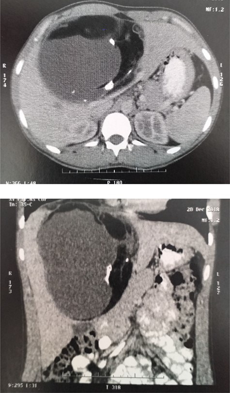 Enhanced CT: ill-defined contrast-enhancing, multilobulated cystic lesion involving segments II, III, VI and VIII.