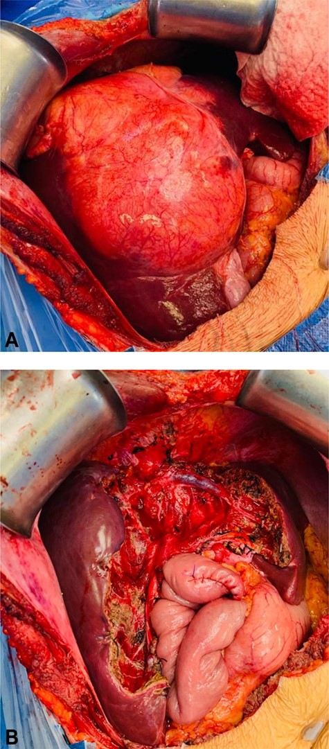 (A) In situ mass, occupying segments II, III, VI, V and VIII. (B) Post resection, visualizing right and left suprahepatic vein, and Y-Roux hepaticojejunostomy.