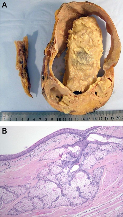 (A) Macroscopic specimen. (B) Microscopic slice where hair and skin tissue are appreciated.