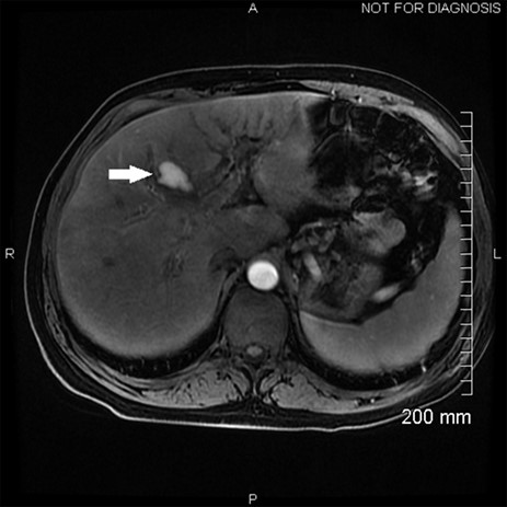 MRI showing the hepatic artery pseudoaneurysm.