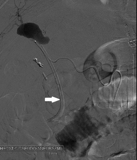 Angiography showing the hepatic artery pseudoaneurysm filling, with the arrow pointing to the catheter used for embolization.