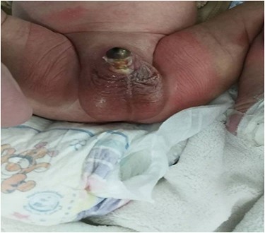 Glans gangrene of the infant due to circumcision using monopolar electrocautery.