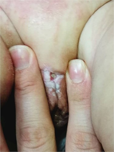 Drop of the necrotic glans. Note the accessibility of the urethral opening.