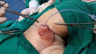 Scrotal flap is used to cover the urethral opening, spongy body and cavernous bodies, which will later form the shaft of the penis.