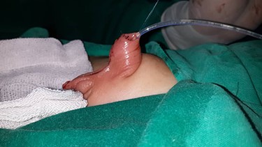 Surgical incision was made 2 cm away from the urethral opening, and a suture was later performed on the midline.