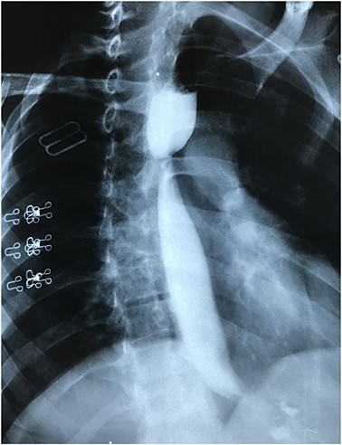 Barium study showing stricture at the middle third of the esophagus with proximal dilatation.