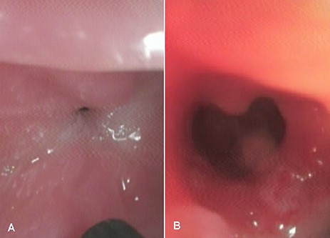 An endoscopic view showing (A) esophageal stricture before endoscopic dilatation, and (B) the site of the stricture after successful endoscopic dilatation.