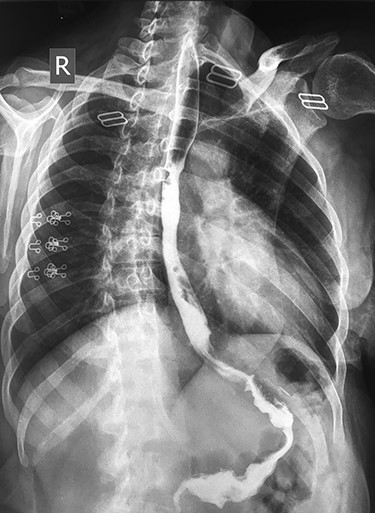 Barium study showing the passage of the contrast agent to the sleeved stomach with no evidence of stricture after successful endoscopic dilatation.