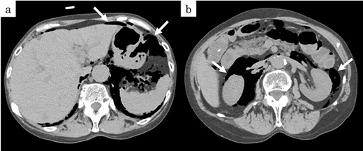 Preoperative CT showed (a) pneumoperitoneum (arrows) and (b) a massive pneumoretroperitoneum (arrows).