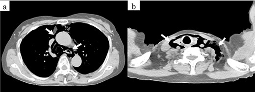Preoperative CT showed a massive pneumomediastinum (arrows).