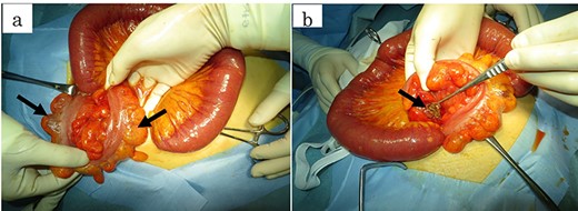 Intraoperative findings revealed (a) pneumatosis changes in the mesenterium (arrows) and (b) perforation of the sigmoid colon at the side of the intramesenteric space (arrows).