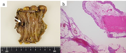 (a) The fixed sample showed a perforation site on the mesenteric side of the sigmoid colon (arrows). (b) The pathological specimen (haematoxylin and eosin, ×12.5) showed a rupture of the muscular layer, compatible with diverticular perforation.