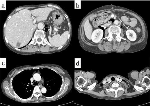 Postoperative CT showed a decrease of the pneumoretroperitoneum and pneumomediastinum (arrows).