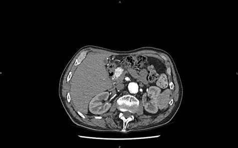 CT in axial section, arterial phase: visualization of a hypervascular structure at the level of the pancreas head.