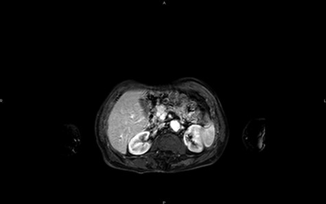 MRI in axial section, phase T1 + gadolinium: visualization of a structure with hypersignal at the level of the head of the pancreas.