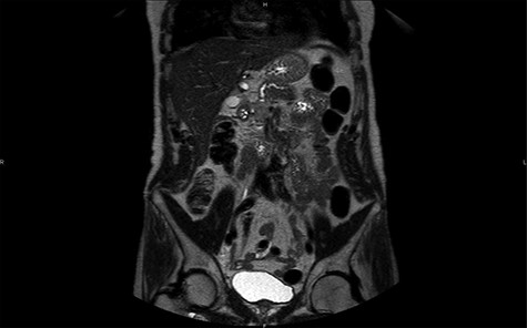 MRI in coronal section, T2 phase: visualization of a compression of the main pancreatic duct.