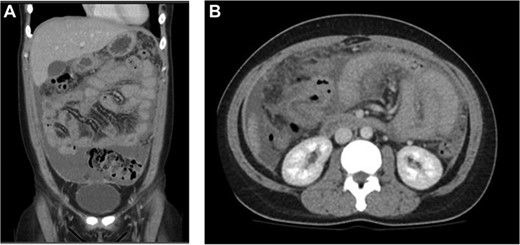 (A) Coronal and (B) axial views: diffuse peritoneal thickening with moderate ascites and encasement of small bowel loops.